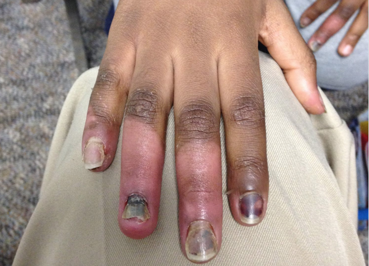 An extreme case of frostbite suffered by a patient of Dr. Paul Caulford at the Canadian Centre for Refugee and Immigrant Healthcare An extreme case of frostbite suffered by a patient of Dr. Paul Caulford at the Canadian Centre for Refugee and Immigrant Healthcare